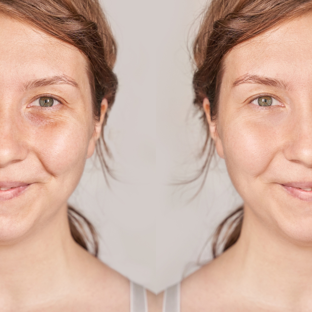 Which Retinol is best for beginners or sensitive skin? KLAPP